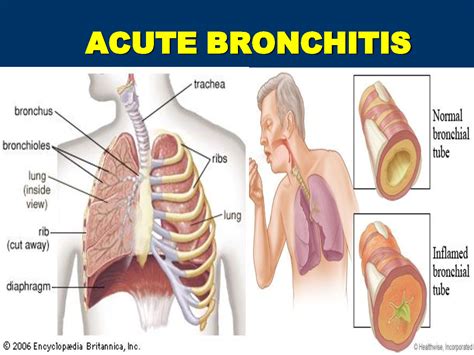 Acute Bronchitis In Adults And Children Causes, Symptoms, Diagnosis ...