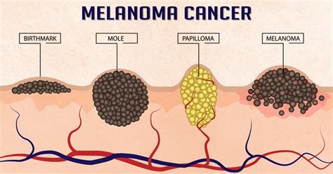 Melanoma cancer (skin cancer)- healthreactive.com :: Health Reactive ...