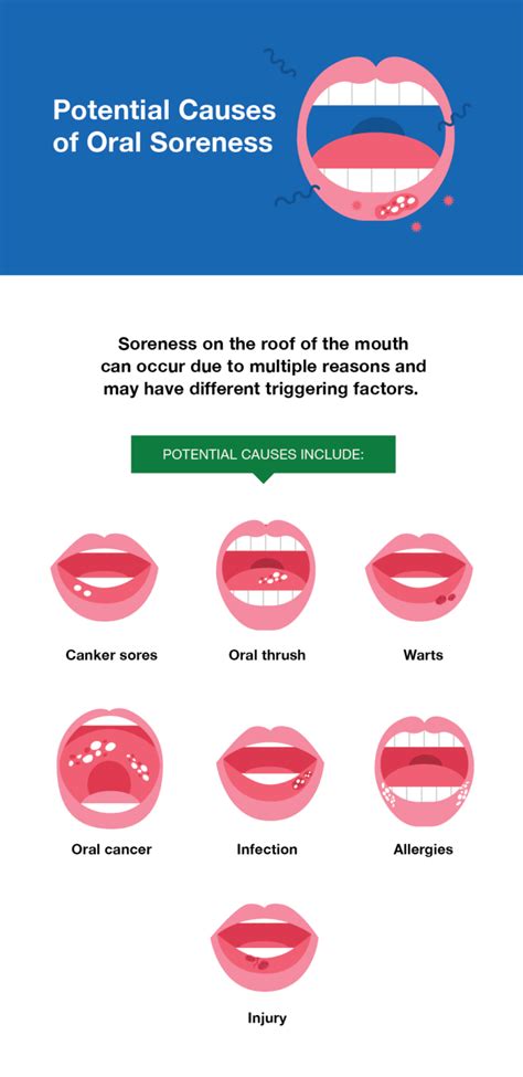 Sore Roof of Mouth: Causes & Treatment - SmartMouth