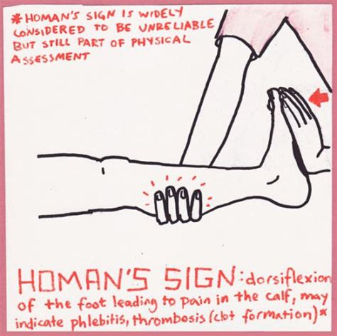 homans sign | homan's sign | Tumblr | Homans sign, Nursing school ...