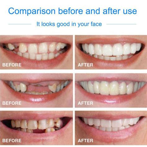 Drop Ship Smile Maker Fit Flex Teeth with Box Fits Snap on Smile False ...