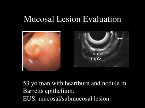 PPT - Endoscopic Mucosal Resection PowerPoint Presentation - ID:303427