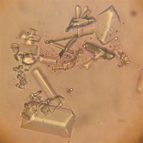 Picture of struvite crystals in the urine of a 3.5 year old dog ...