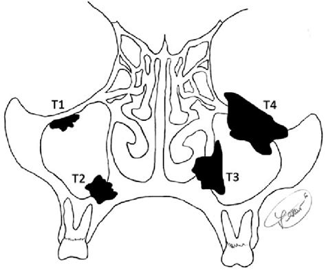 A diagrammatic representation of tumor stage, based on a maxillary... | Download Scientific Diagram