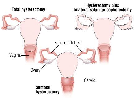 Hysterectomy Guide | Drugs.com