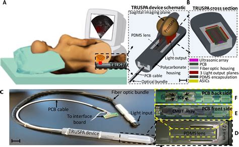 Prostate Anatomy Ultrasound