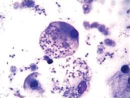 Histoplasmosis: Causes, Symptoms, Risks & Treatments