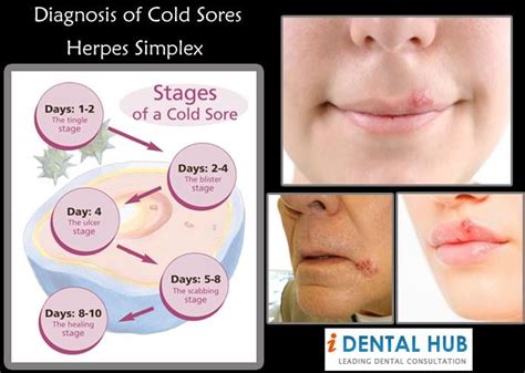 Diagnosis of Cold Sores Herpes Simplex | Dental Care @ Identalhub ...