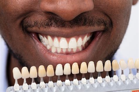 Dental Veneers vs. Crowns: What's the Difference? - Allred Dental