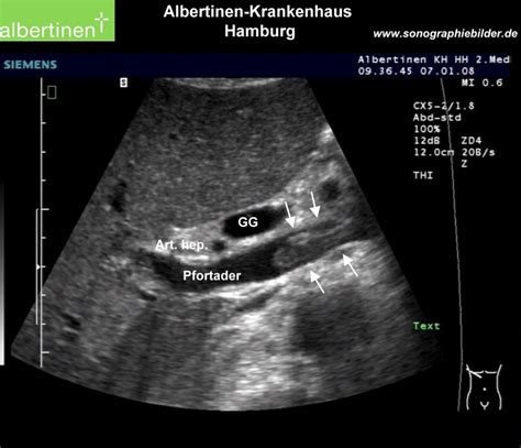 Portal Vein Thrombosis Ultrasound