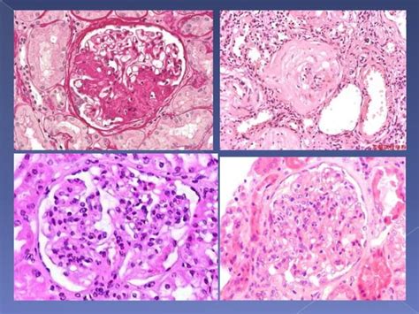 Interpretation of renal biopsy