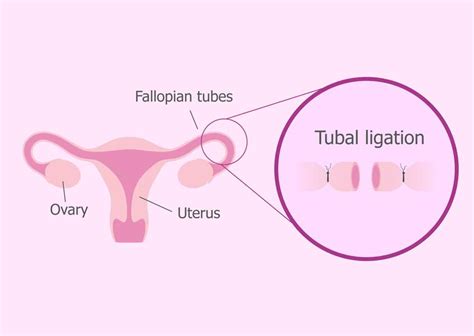 Tubal Ligation Procedures - Magnolia Regional Health Center