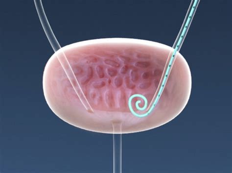 Video - Ureteral Stent Placement - HealthClips Online