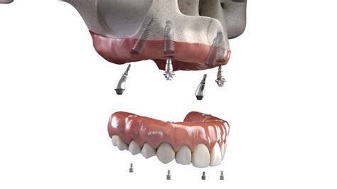 All-on-X Dental Implants - Beaumont Dental Center