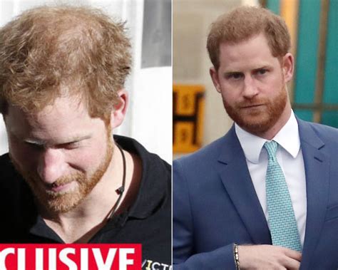 A Look into Prince Harry’s Hair Journey! A Royal Hair Transplant