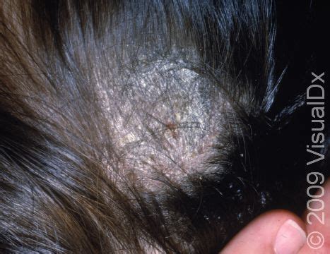 Tinea Capitis (scalp Ringworm): Causes, Symptoms, And