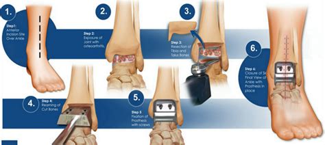 Facts About Ankle Replacement Surgery