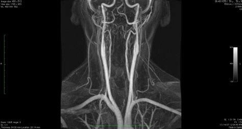 Kari Muth RN, BSN: Understanding Fibromuscular Dysplasia