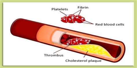 Fibrinolysis - Assignment Point