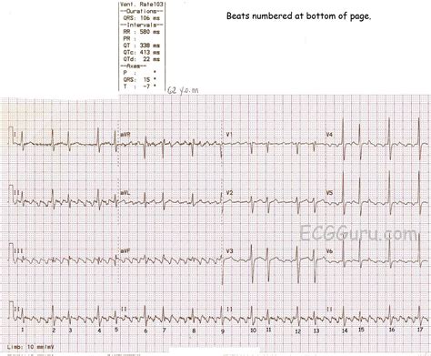 Atrial Flutter With Variable Conduction | ECG Guru - Instructor Resources