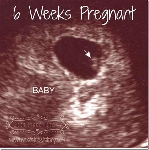 6 Week Pregnancy Ultrasound | All About Pregnancy | Pinterest | Pregnancy ultrasound, Ultrasound ...