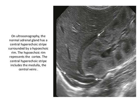 Adrenal Adenoma Radiology