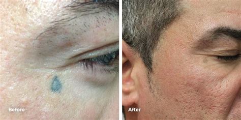 Face Tattoo Removal Services | Removery