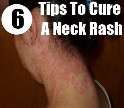 How To Cure A Neck Rash - Home Remedies For Neck Rashes | Natural Home Remedies Fitness Guide