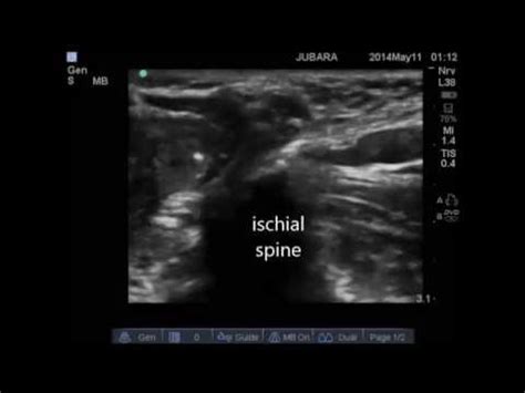 ultrasound guided pudendal nerve block - YouTube