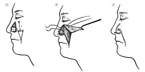 Reliability of the Melolabial Flap for Alar Reconstruction | JAMA ...