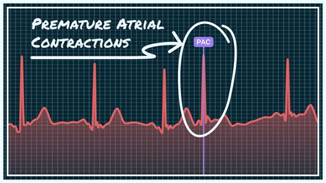 Premature Ventricular Contractions Vs Premature Atrial Contractions