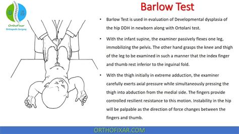 Developmental Dysplasia Of The Hip, Hip Dislocation, Greater Trochanter ...