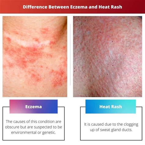 Eczema vs Heat Rash: Difference and Comparison