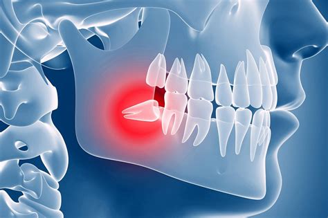 Wisdom Teeth Removal - 5 Awesome Tips for Recovery | Elite Dental Care