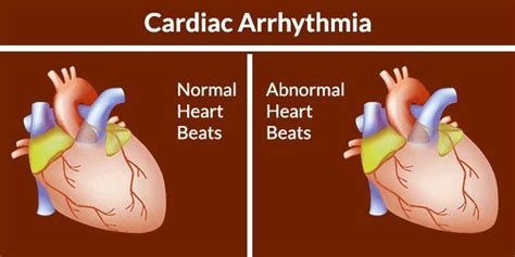 What Is Cardiac Arrhythmia | Heart Rhythm Disorder | Cardiac arrhythmia, Heart rhythm disorder ...