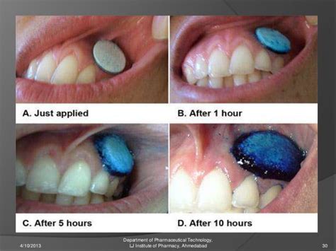 Buccal drug delivery system