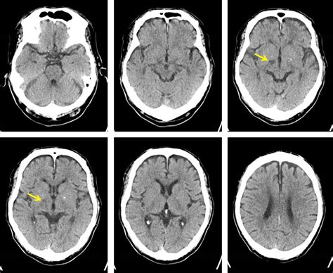 Hemiballismus caused by subthalamic infarction – Radiology Cases