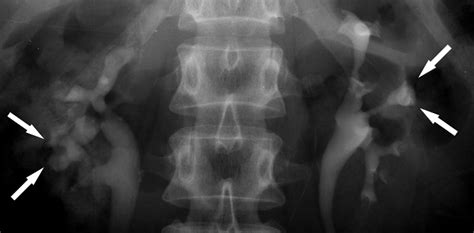 Renal Papillary Necrosis: Review and Comparison of Findings at Multi–Detector Row CT and ...