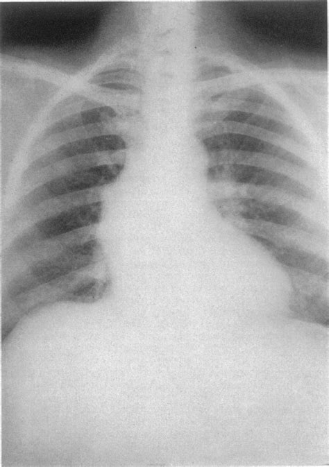 Stages Of Copd And Emphysema