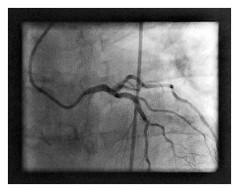 Left anterior oblique view of the left coronary artery. A JL4 catheter... | Download Scientific ...