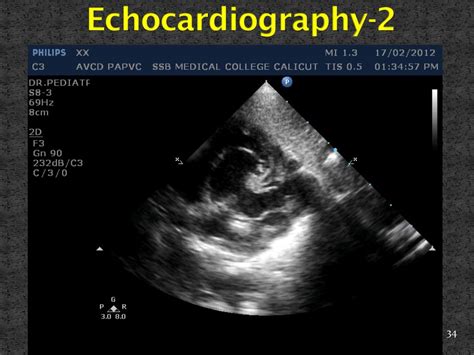 PPT - Atrioventricular Septal Defect PowerPoint Presentation, free download - ID:6596797