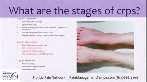 Basics of RSD and CRPS Treatment at Top Tampa Pain Centers (813) 666 ...