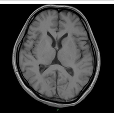 Mri Brain Ventricle Anatomy