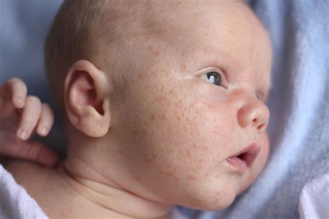 Why Does My Newborn Have Acne?