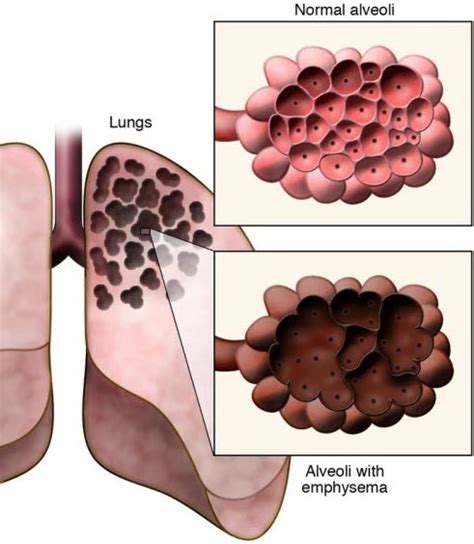 Emphysema: Causes, Symptoms, Diagnosis & Treatment » How To Relief