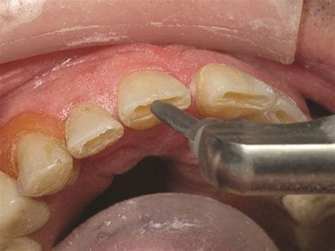 Show Your Work: Treating Incisal Edge Wear by Dr. Marvin Fier - Dentaltown