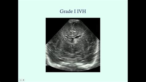 Intraventricular Hemorrhage Grades