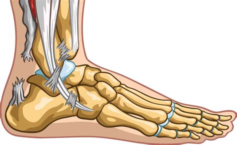 ACHILLES TENDON RUPTURE