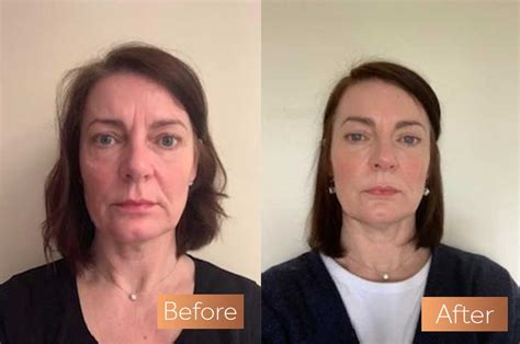 Absolute Collagen Before and After Pictures | Incredible Results ...