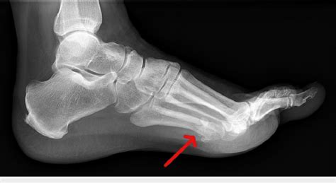 Lateral X-ray of the left foot The image shows well-corticated ossicles... | Download Scientific ...